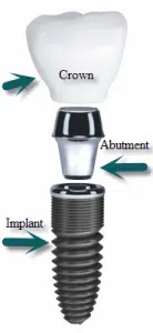 Dental Implant