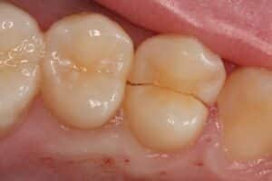 cracked tooth clinical example