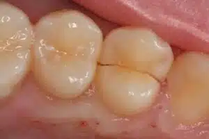 cracked tooth clinical example