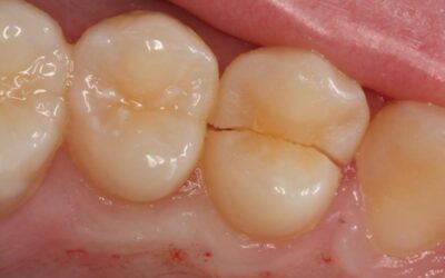 Cracked Tooth: Yet Another Example