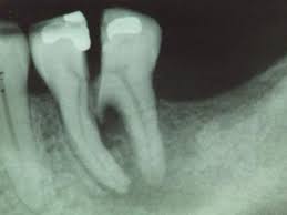 Cracked Tooth Syndrome