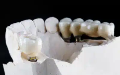 Do Dental Implants Make Financial Sense?