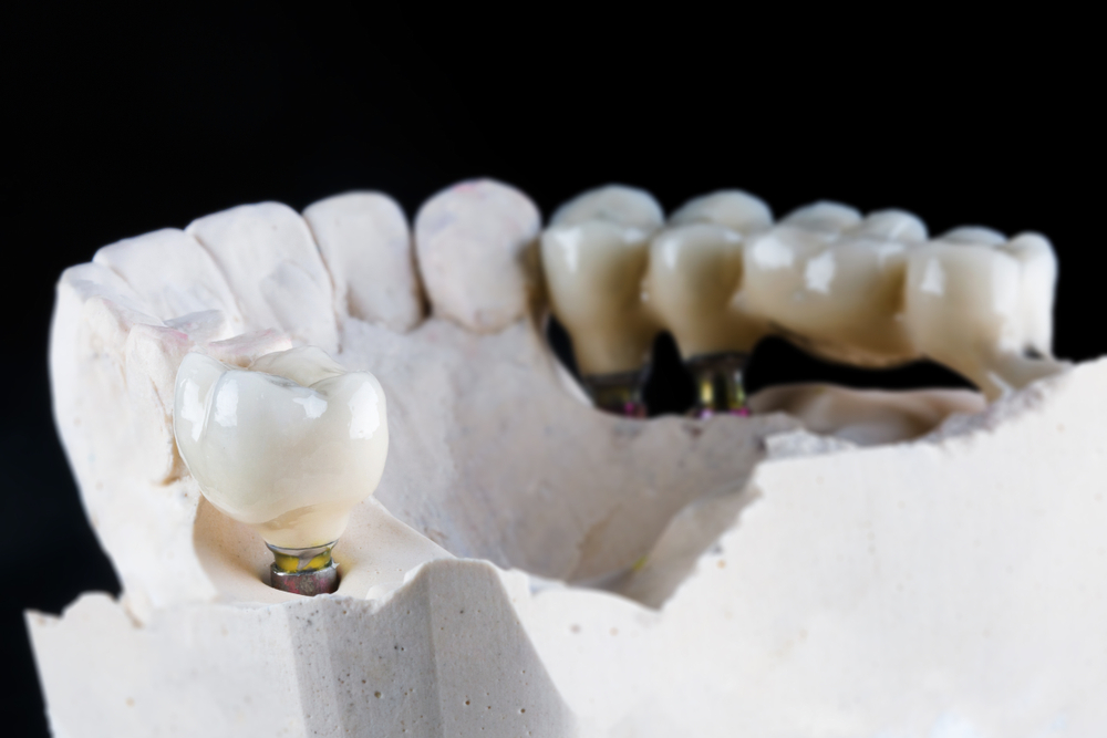 Do Dental Implants Make Financial Sense?