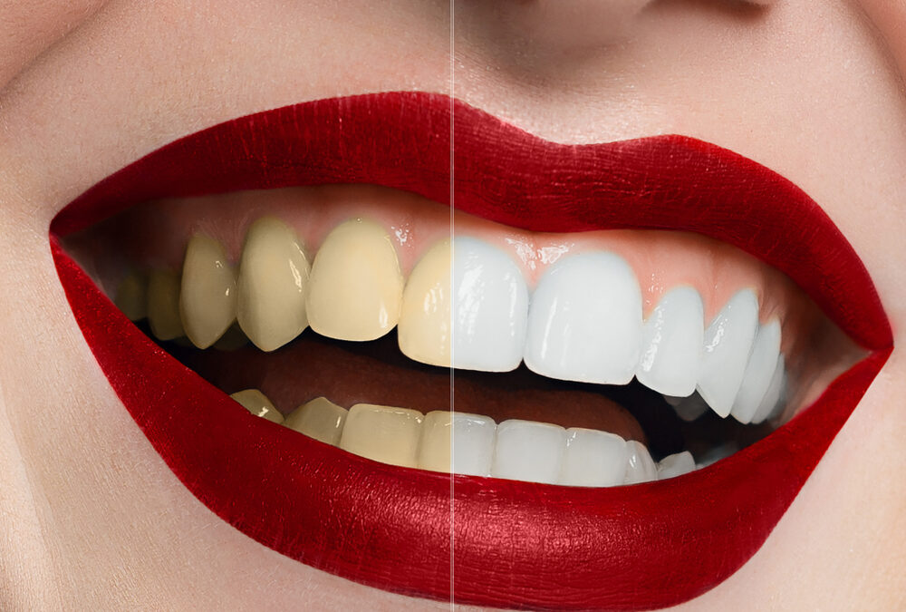 The Sparkling Myth: Debunking the Truth About Teeth Whitening