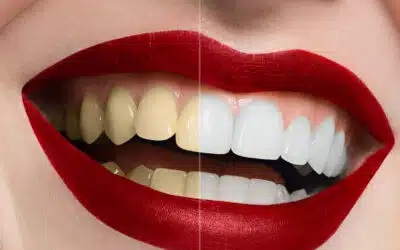 The Sparkling Myth: Debunking the Truth About Teeth Whitening