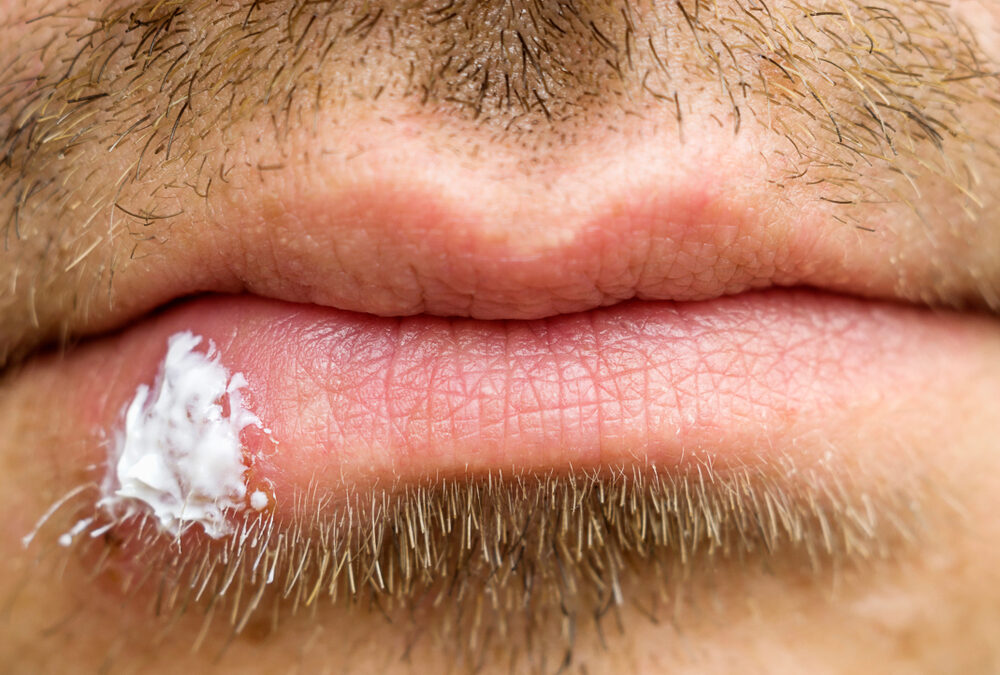 Canker Sores vs. Cold Sores: Understanding the Discomfort in Your Mouth