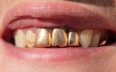 Fang Fashion: The History of Gold Teeth