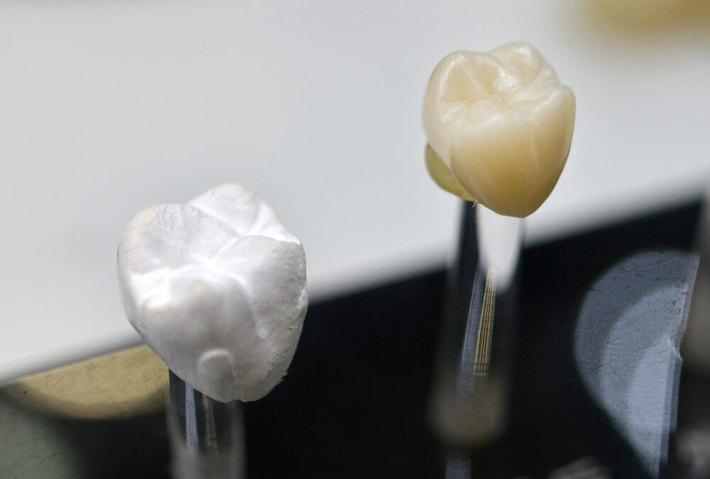 Decoding Dental Procedures: Inlays, Onlays, and Crowns – A Comprehensive Guide