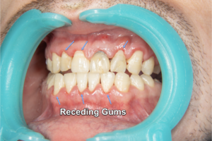 Image depicting receding gums