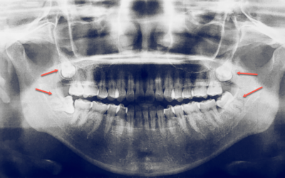 Why Do We Have Wisdom Teeth? The Evolutionary Mystery