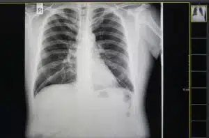 xray signifying effects of smoke inhalation