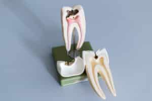 early signs of dental disease tooth models