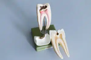 early signs of dental disease tooth models