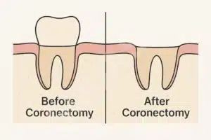 Coronectomy diagram showing wisdom tooth before and after surgery, with crown removed and roots left in jawbone.