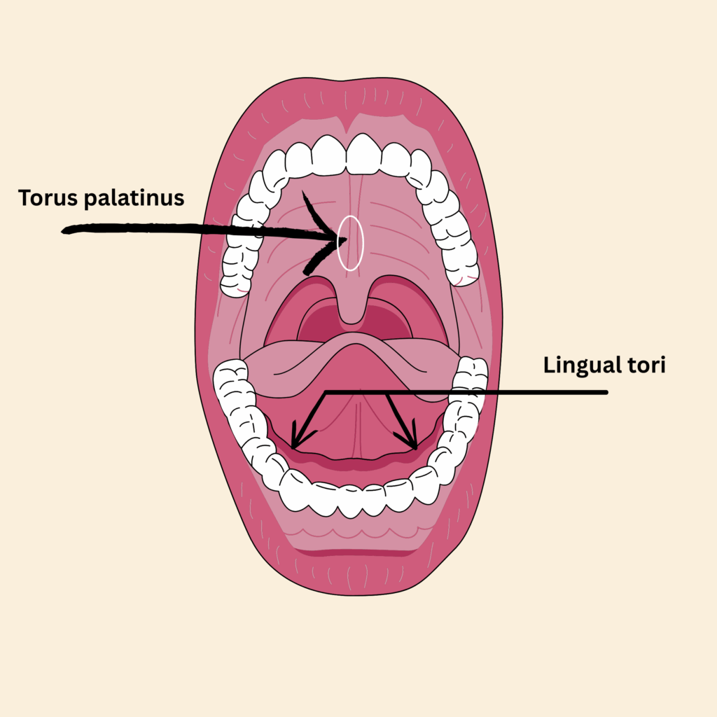 Educational diagram of the mouth showing oral tori and exostoses, with arrows labeling torus palatinus on the hard palate and lingual mandibular tori on the inner side of the lower jaw. Used to illustrate common locations of bony growths in the oral cavity.