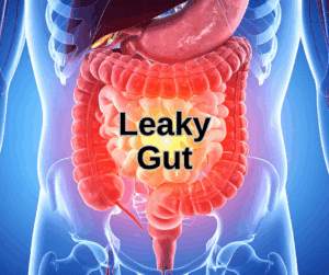 Medical illustration showing the human digestive system highlighting the intestines with inflammation, representing leaky gut syndrome.