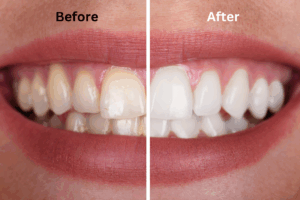Image illustrating concept of teeth whitening vs. bleaching by showing how whitening removes surface stains versus bleaching that lightens deep discoloration inside enamel.