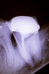 Dental xray showing infection and abscess vs cyst