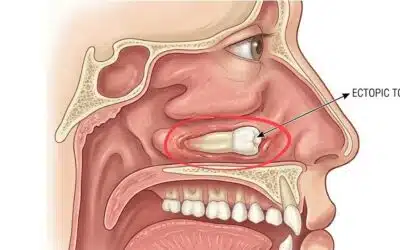 Ectopic Tooth in Nose: 5 Strange Cases That Defy Anatomy