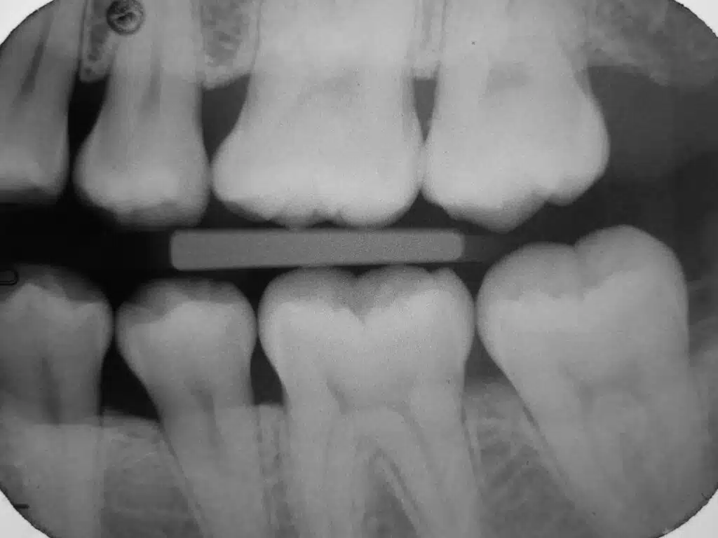 tooth pain but x-ray normal dental evaluation