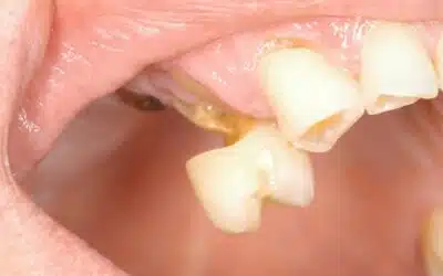 Toothbrush Abrasion: The Real Cause of Gumline Notches May Surprise You